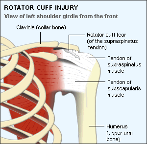 rotator_cuff_tear